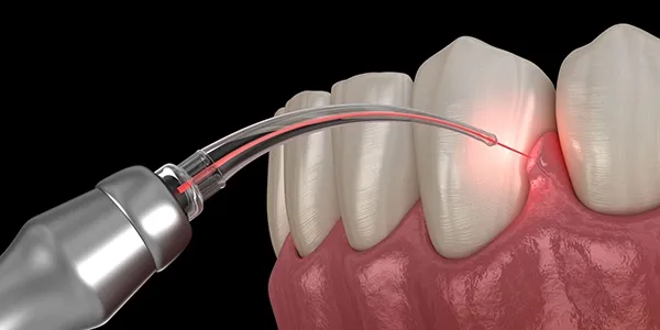 Dental laser used for minimally invasive gum disease treatment